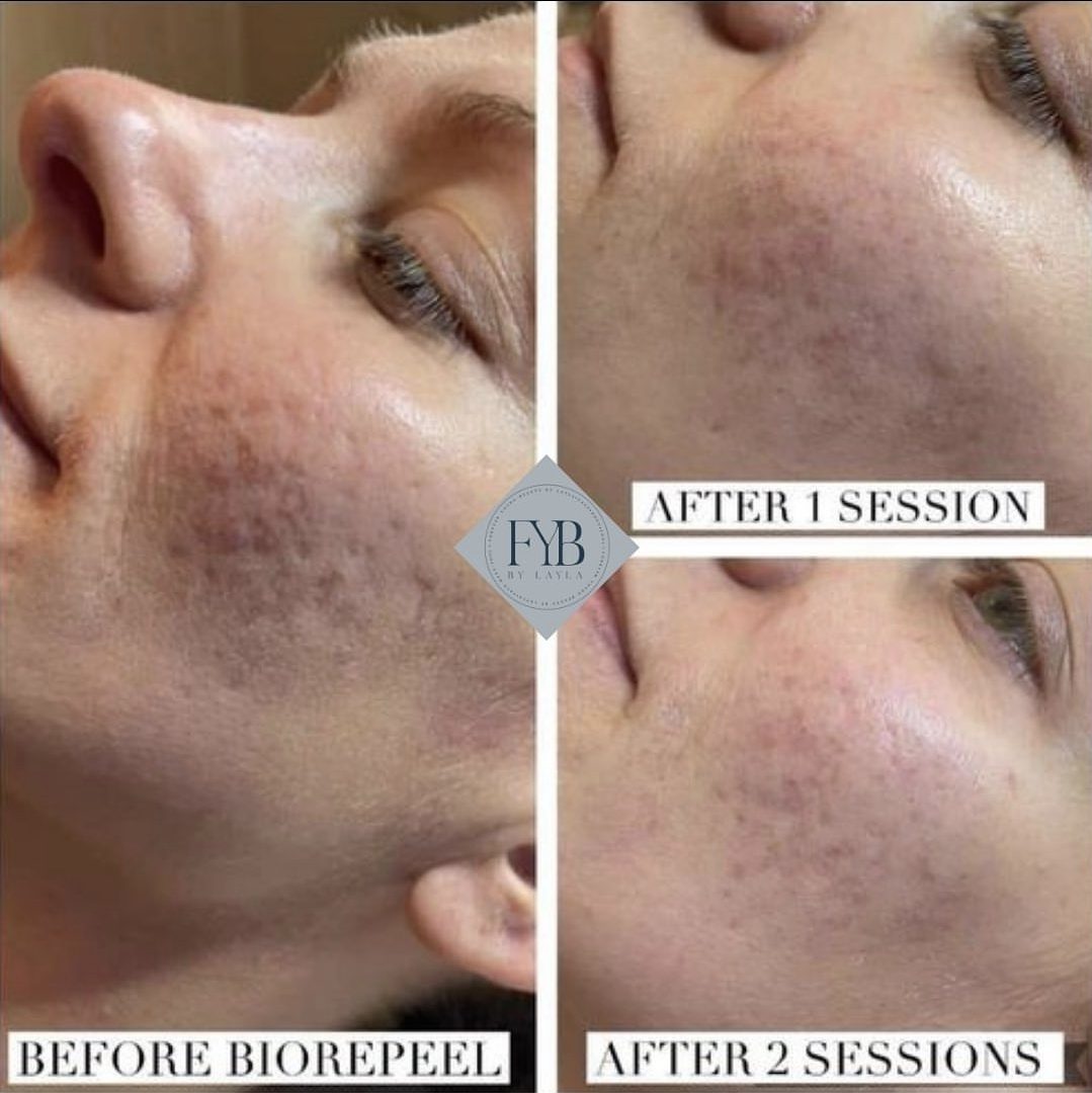 Cheek pigmentation and redness before BioRePeel, after one session and after two sessions