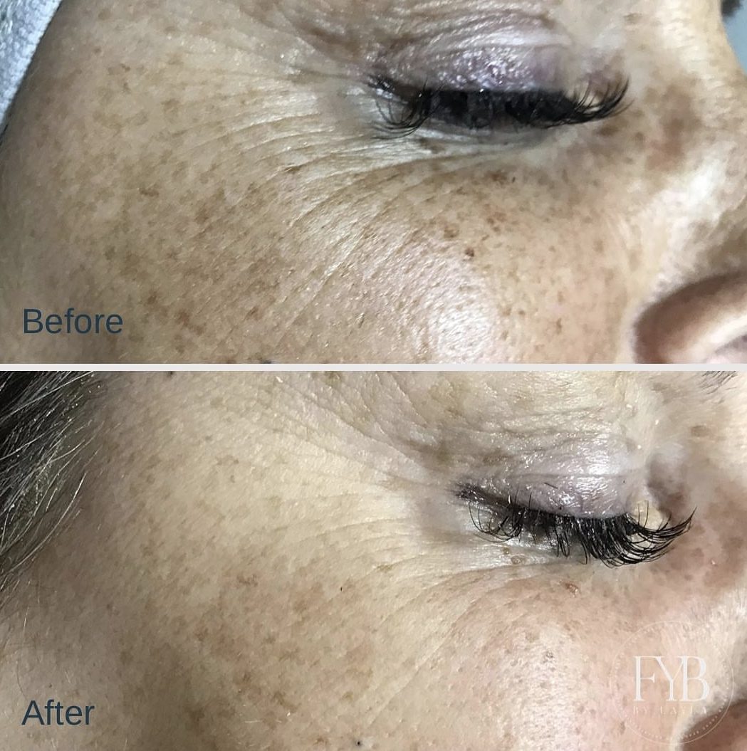 Softened fine lines and improved texture around the eye area after treatment
