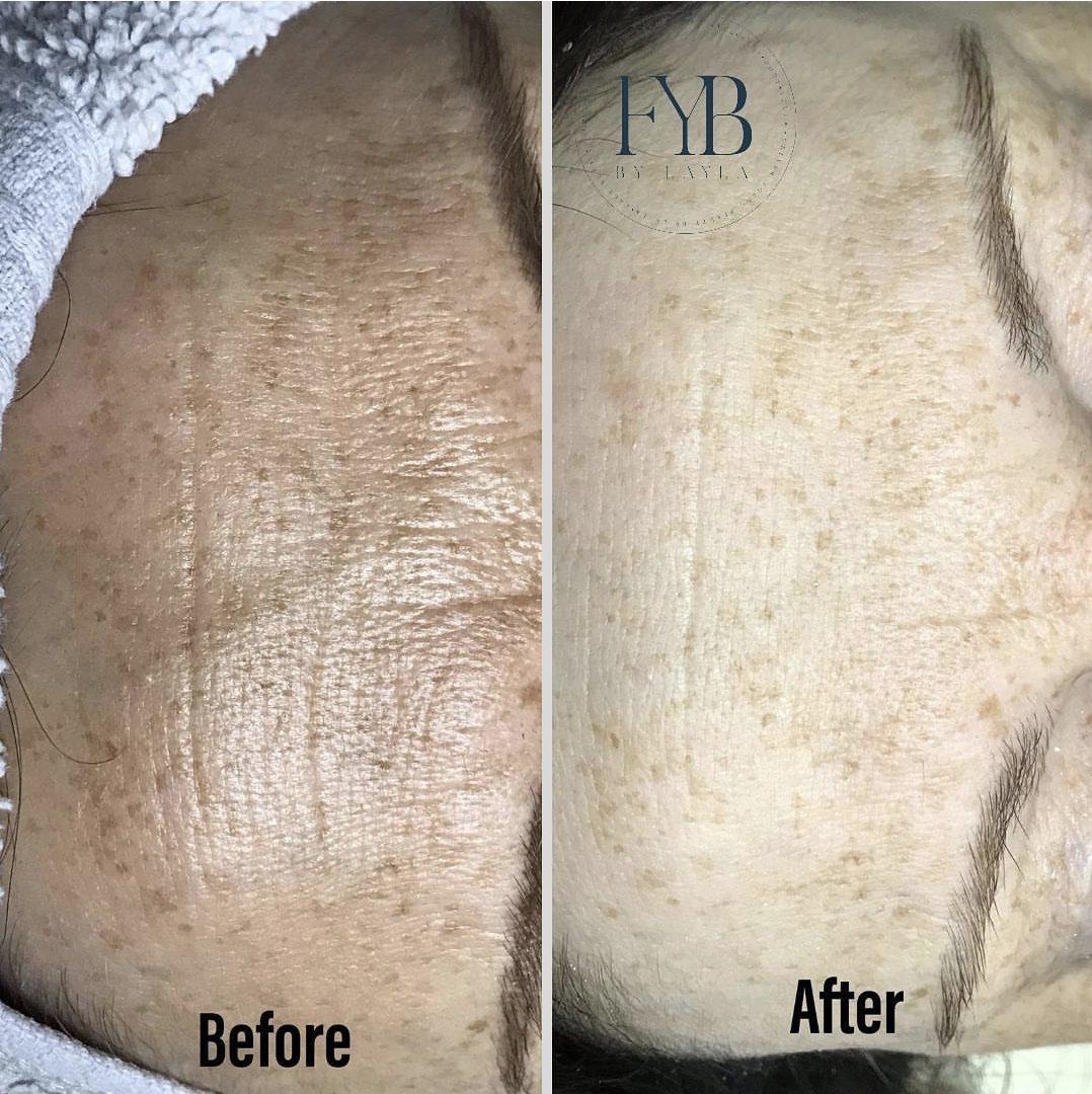 Smoother forehead texture and softened fine lines after treatment