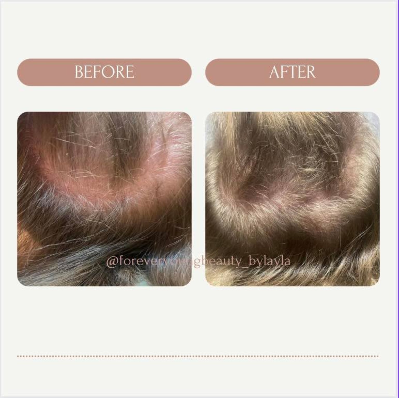 Scalp hair-growth treatment before and after comparison