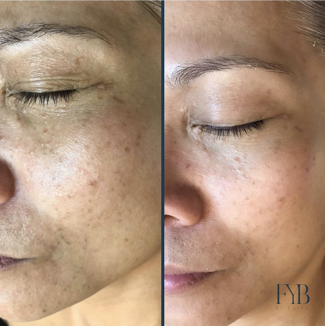 Reduced pigmentation and more even skin tone across the cheek and eye area after treatment